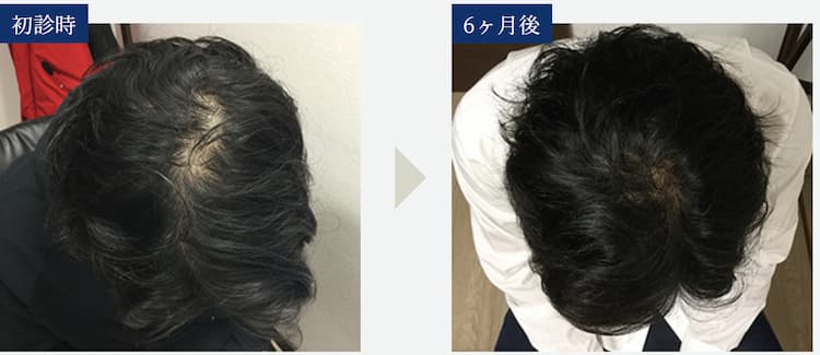 【初診時と6ヶ月後の比較画像】治療法：オリジナル発毛治療+メディカルケア発毛メソセラピー