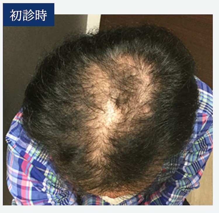【55歳Aさん：初診時の画像】毛の流れがはっきりしていない