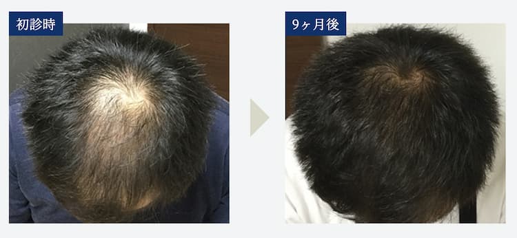 【初診時と9ヶ月後の比較画像】Aさん（34歳）｜頭頂部と生え際の混合型