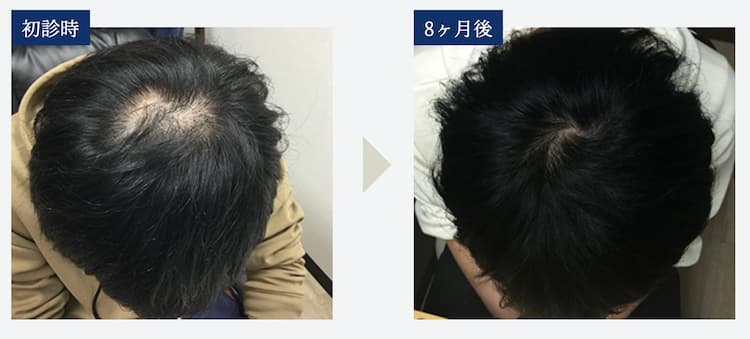 【初診時と8ヶ月後の比較画像】Oさん（28歳）｜頭頂部と生え際の混合型