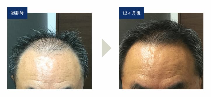 【初診時と12ヶ月後の比較画像】治療法：オリジナル発毛治療+メディカルケア発毛メソセラピー（セット割）