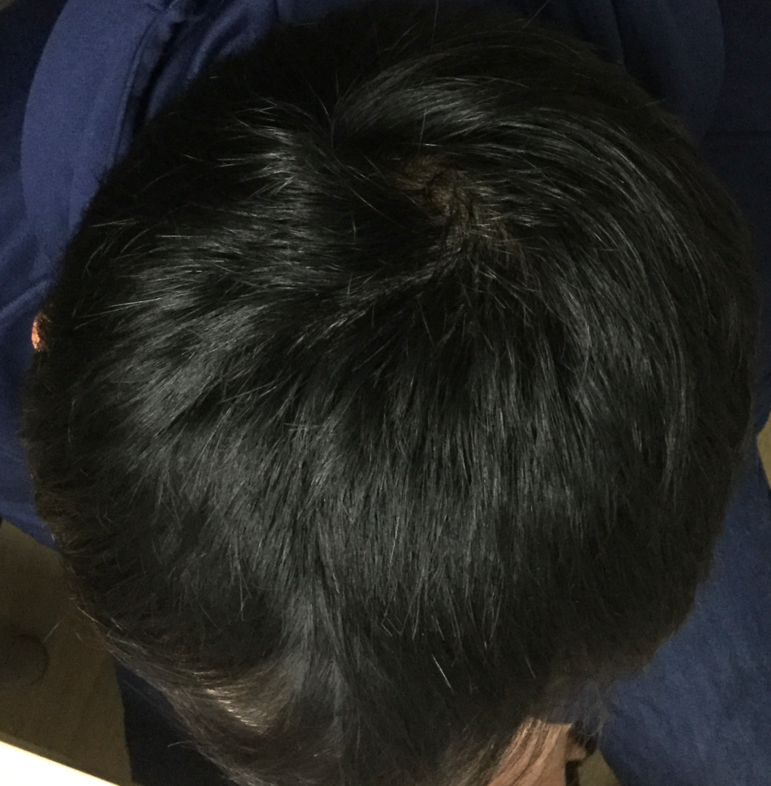 30歳 頭頂部・生え際の混合型 Tさんの頭頂部 4ヶ月後