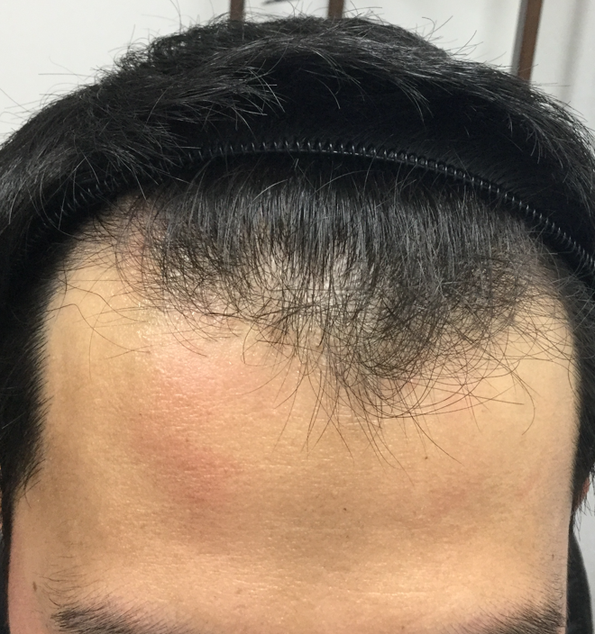 26歳 生え際、頭頂部の混合型 Hさんの生え際 初診時
