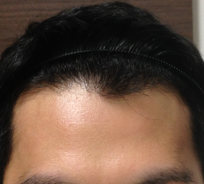 26歳 生え際、頭頂部の混合型 Hさんの生え際 3ヶ月後