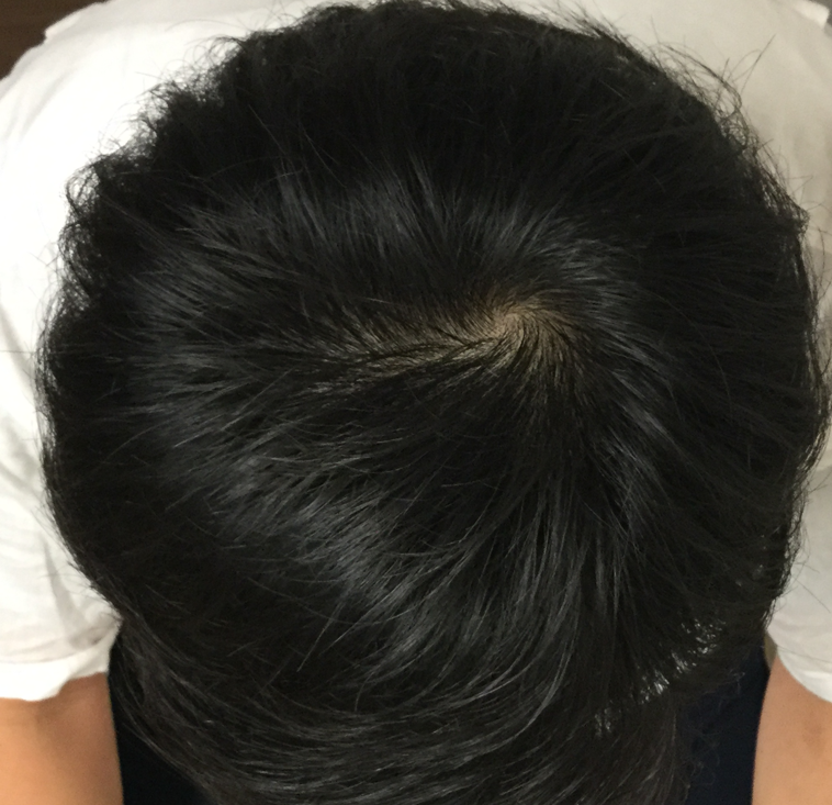 22歳 生え際、頭頂部の混合型 Sさんの頭頂部 2ヶ月後