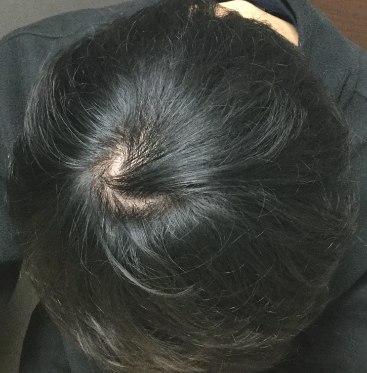 20歳 頭頂部・生え際の混合型 Hさんの頭頂部 5ヶ月後