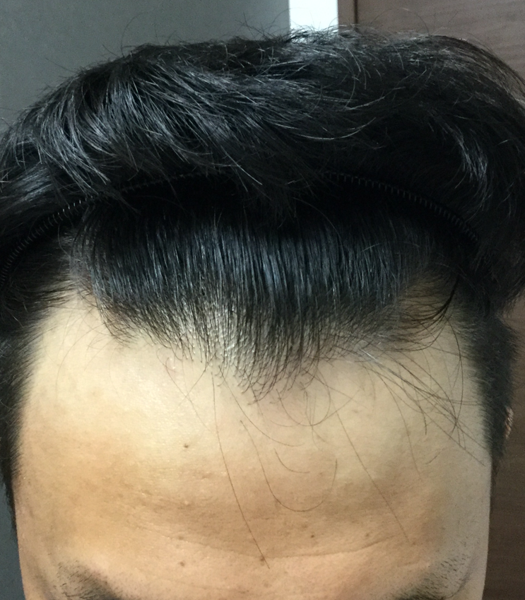 23歳 生え際、頭頂部の混合型 Aさんの生え際 初診時