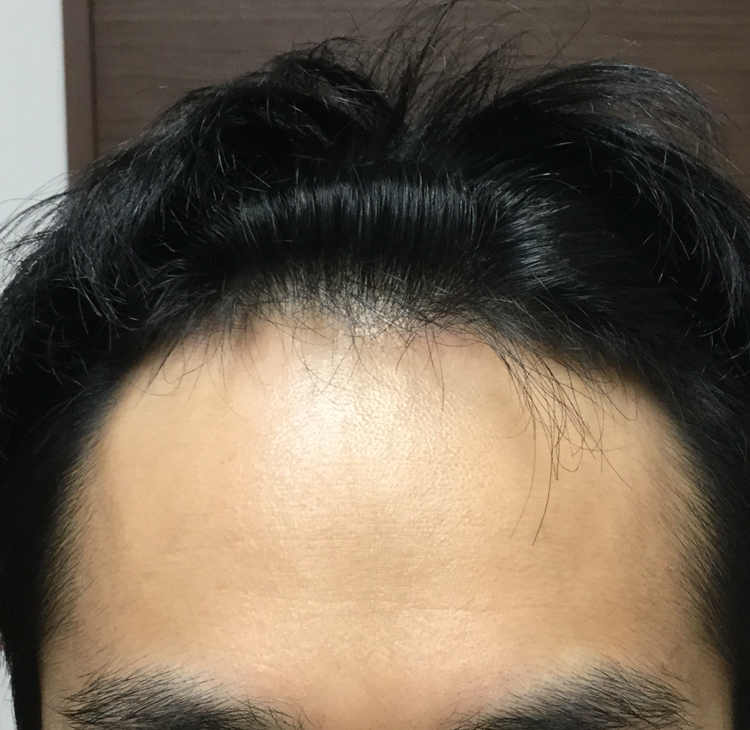 39歳 生え際、頭頂部の混合型 Iさんの生え際 10ヶ月後