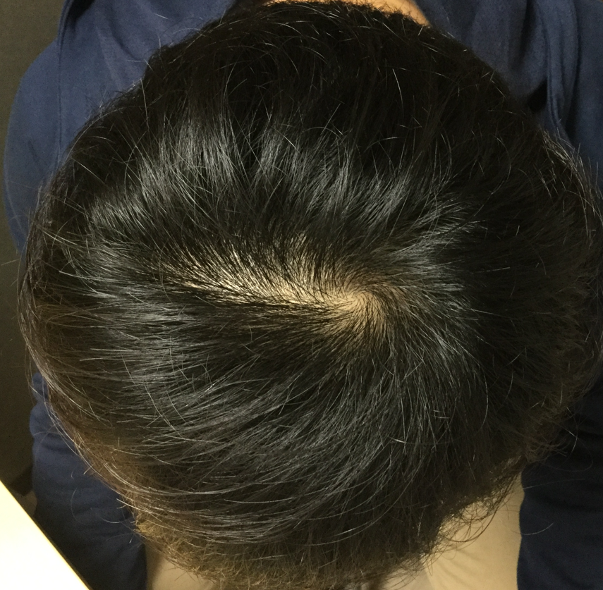22歳 生え際、頭頂部の混合型 Sさんの頭頂部 初診時