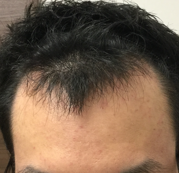 27歳 生え際、頭頂部の混合型 Kさんの生え際 6ヶ月後