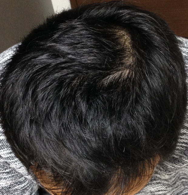 30歳 頭頂部・生え際の混合型 Tさんの頭頂部 初診時