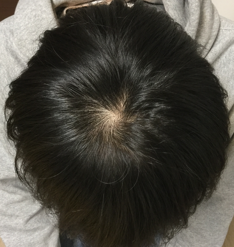 23歳 生え際、頭頂部の混合型 Wさんの頭頂部 初診時