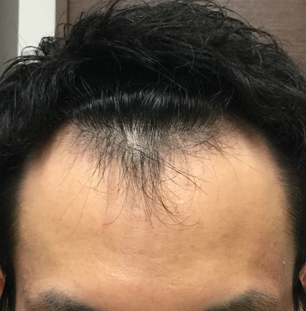 27歳 生え際、頭頂部の混合型 Kさんの生え際 初診時