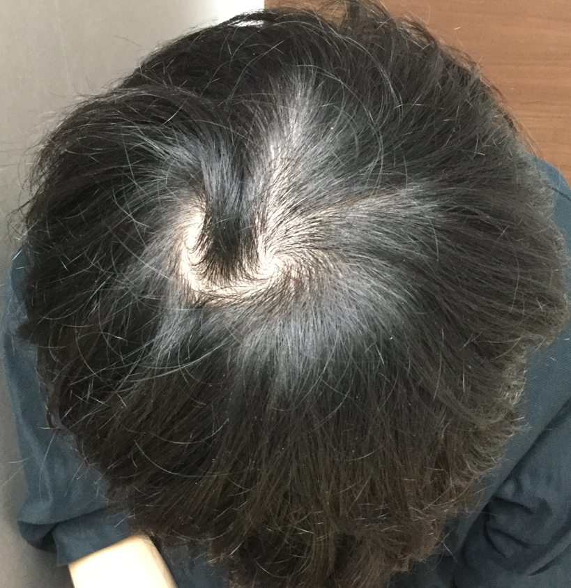20歳 頭頂部・生え際の混合型 Hさんの頭頂部 初診時