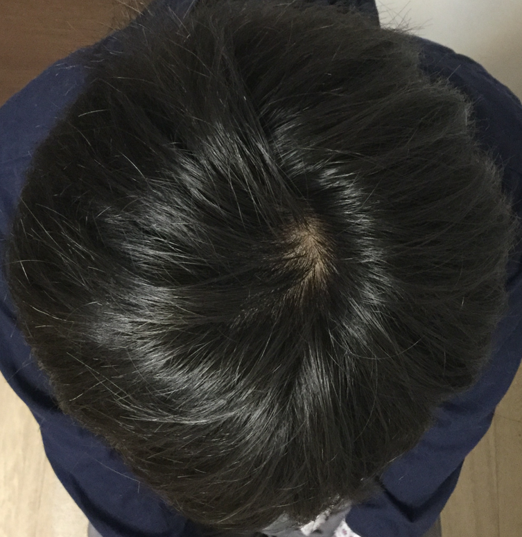 29歳 生え際、頭頂部の混合型 Kさんの頭頂部 7ヶ月後