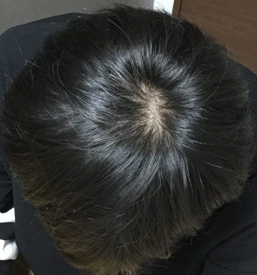 29歳 生え際、頭頂部の混合型 Kさんの頭頂部 初診時
