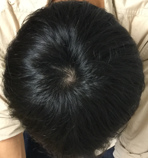 23歳 生え際、頭頂部の混合型 Wさんの頭頂部 4ヶ月後