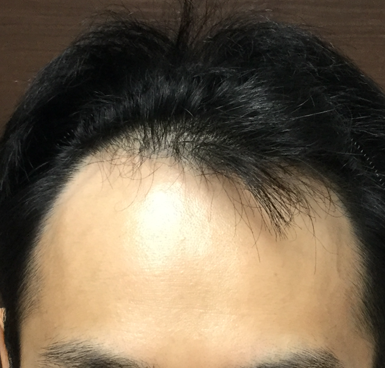39歳 生え際、頭頂部の混合型 Iさんの初診時