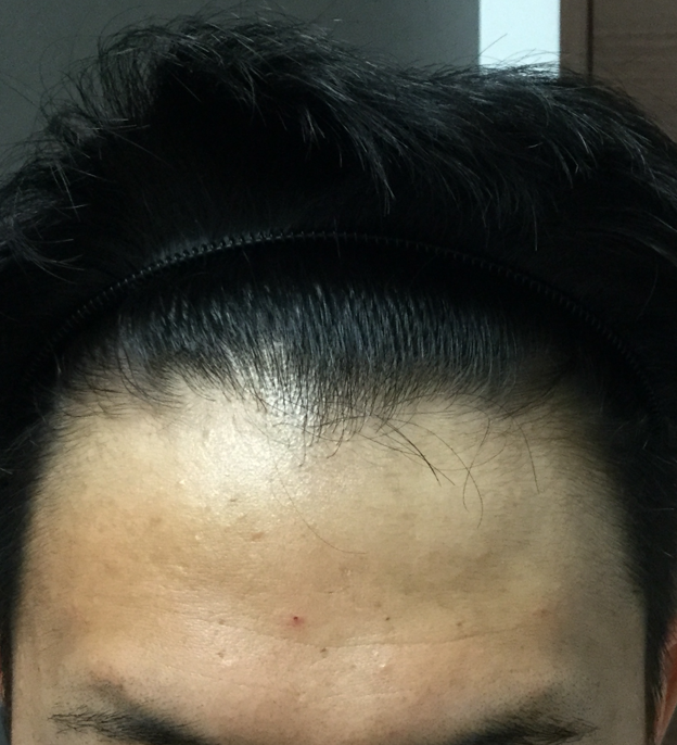 23歳 生え際、頭頂部の混合型 Aさんの生え際 4ヶ月後