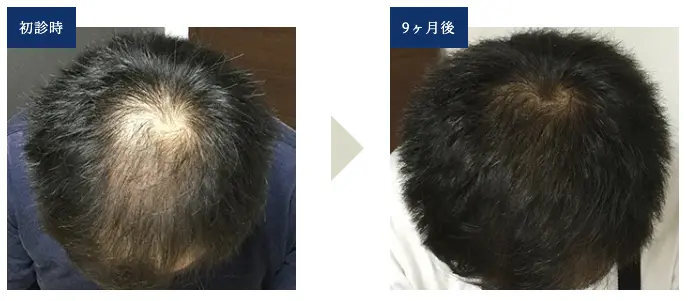 34歳 頭頂部＆生え際型の薄毛の症例