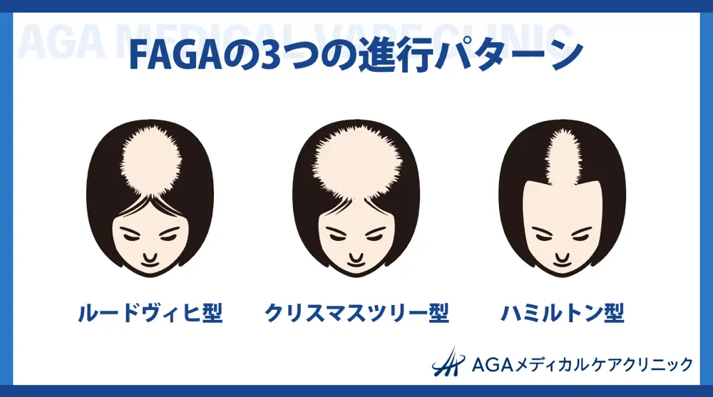 FAGAの3つの進行パターン