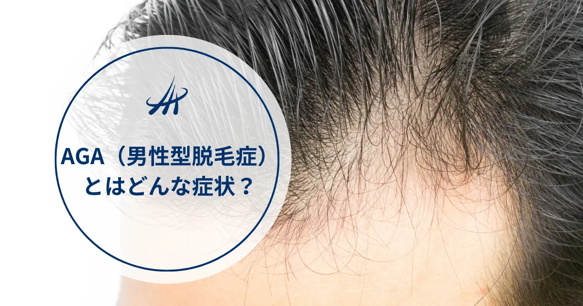 AGA（男性型脱毛症）とはどんな症状？