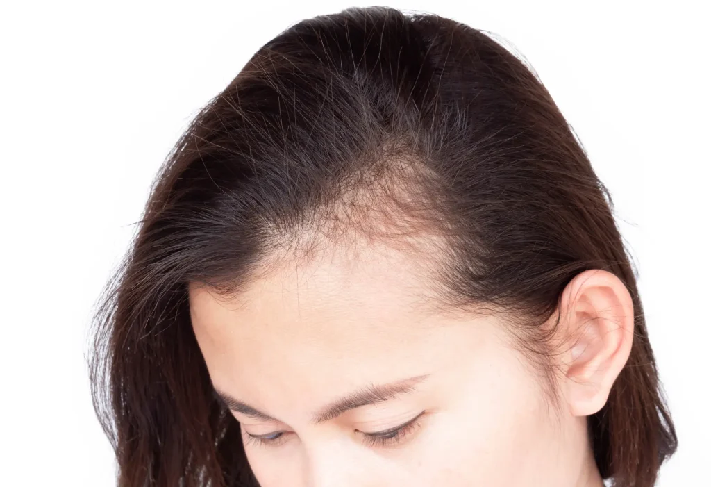 女性の薄毛を治療する主な方法
