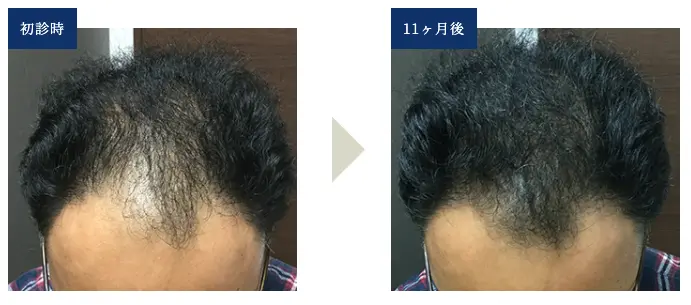 44歳 頭頂部＆生え際型の薄毛の症例