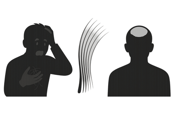 プロペシア休薬直後に起こる抜け毛増加と髪の細化