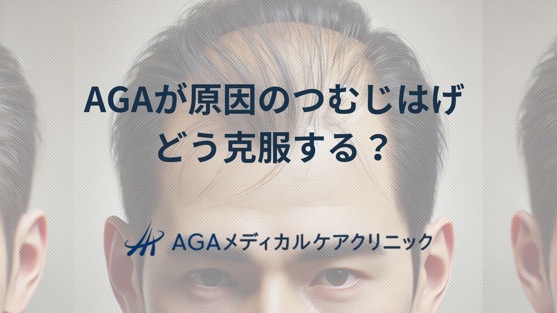 AGAが原因のつむじはげをどう克服する？頭頂部薄毛の対策と改善方法