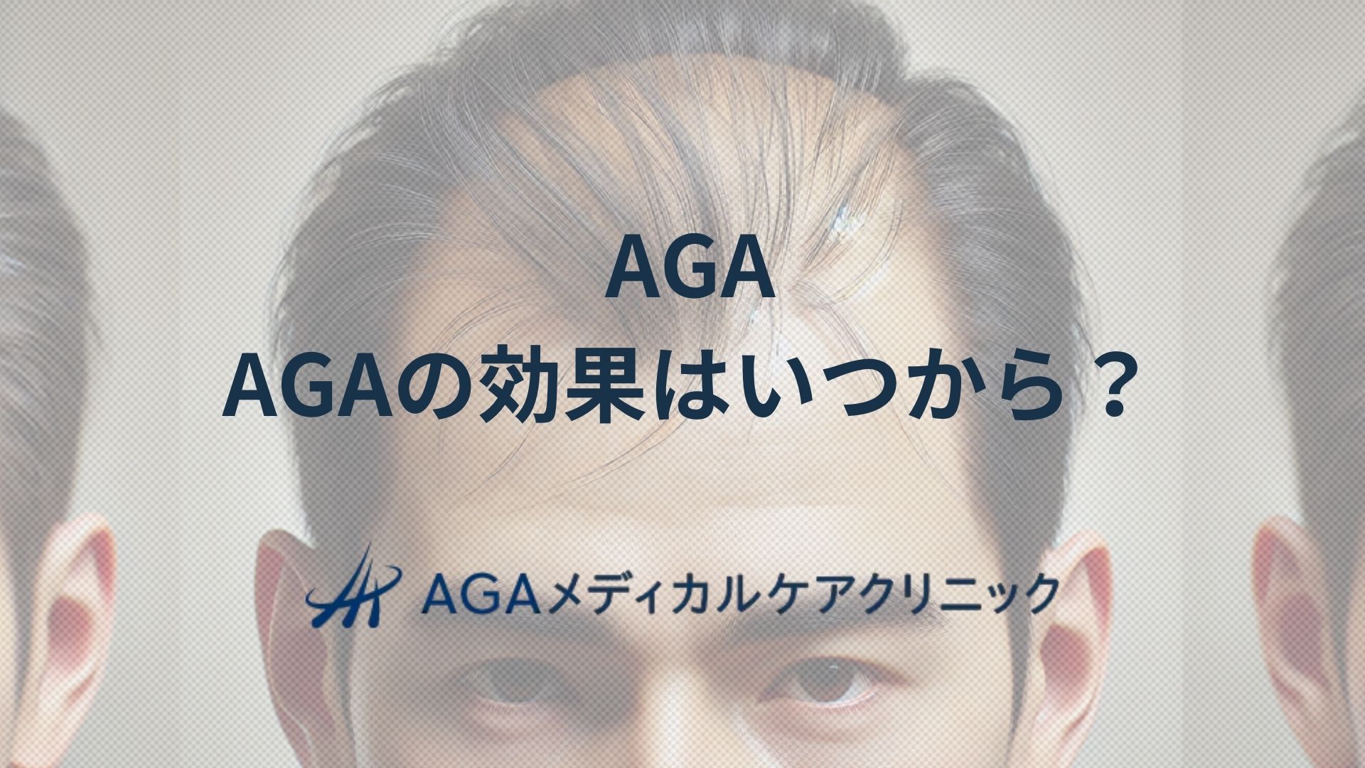 AGAの効果はいつから現れる？男性型脱毛症の治療期間と毛髪改善の流れを医師が詳しく解説