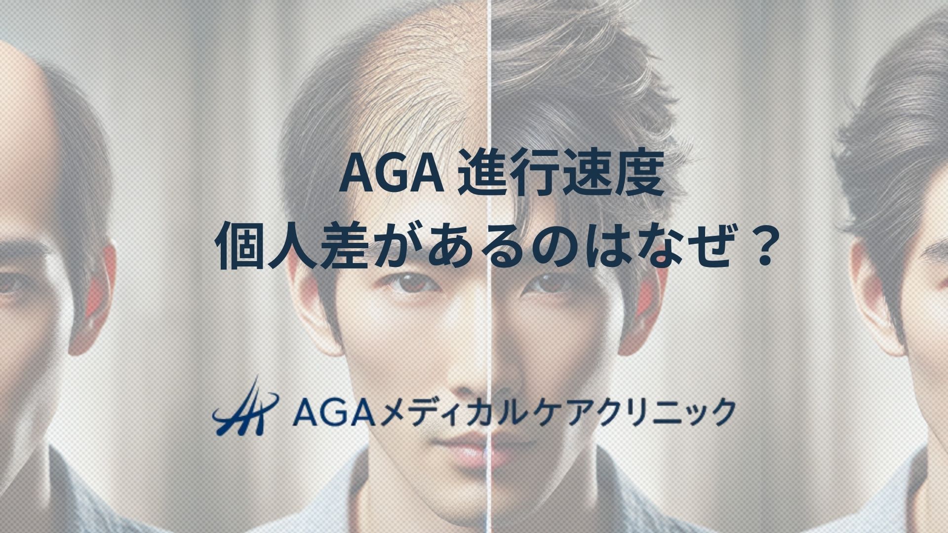 AGA 進行速度に個人差がある理由 発症パターンや抑える方法