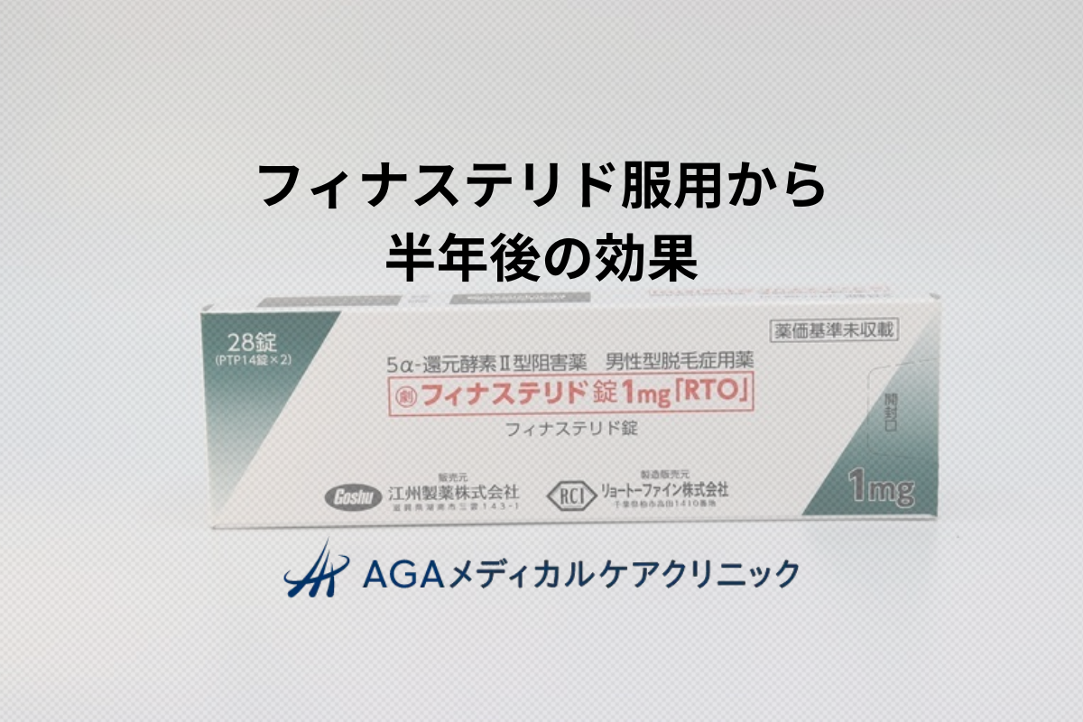 フィナステリドの効果は半年でどのくらい実感できる？薄毛改善の目安と継続のポイント