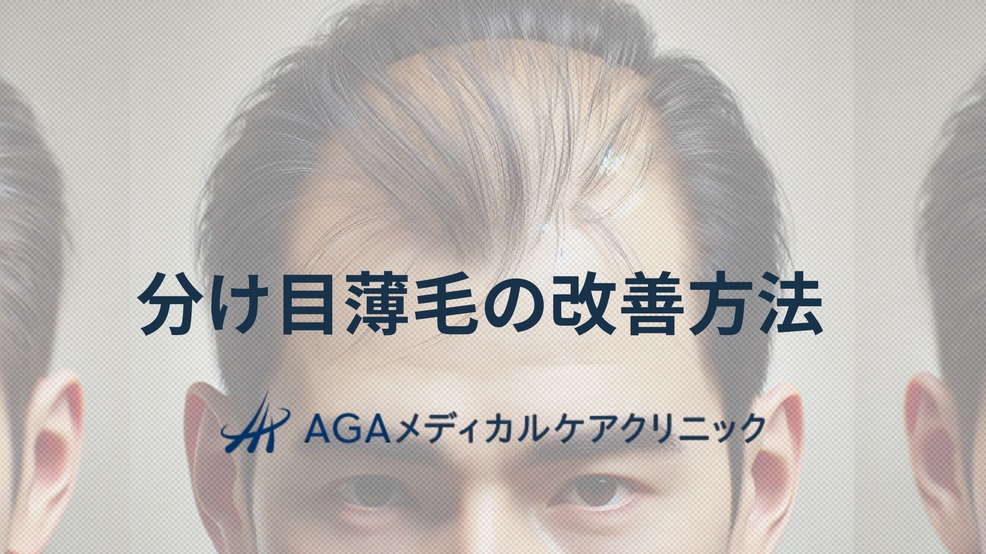 薄毛 分け目