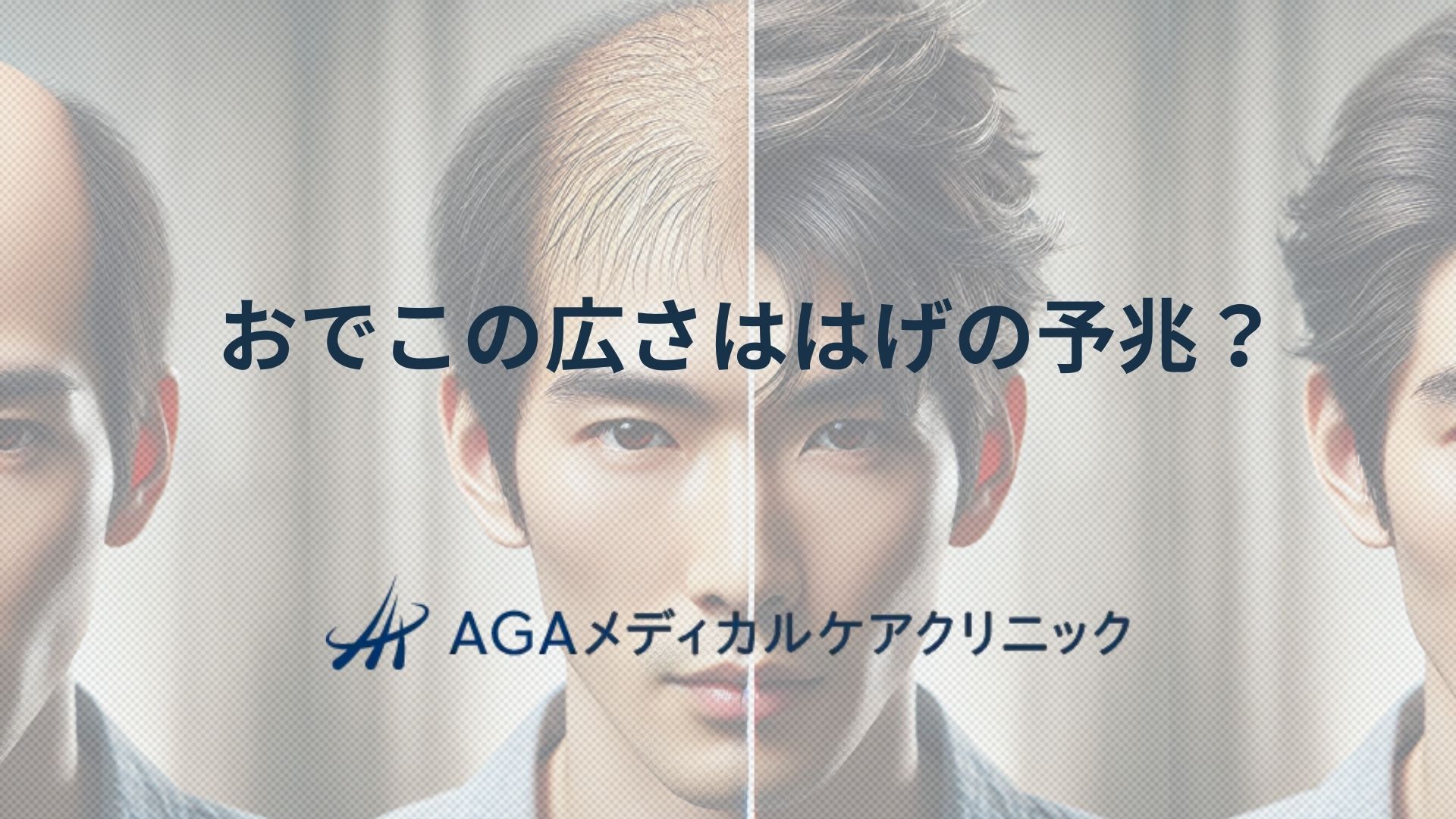 おでこの広さははげの予兆?:生え際後退や薄毛を招く原因からAGAの治療や対策法まで
