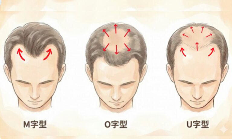 薄毛進行のタイプと段階を把握する